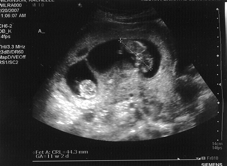 3d ultrasound 20 weeks pregnant. 20+weeks+pregnant+3d+